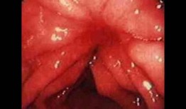 胃炎吃瓜和包米胃口疼,吃瓜與包米引發胃口疼痛