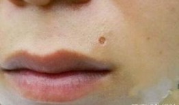 點(diǎn)痣可以吃瓜