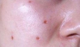 點(diǎn)痣可以吃瓜